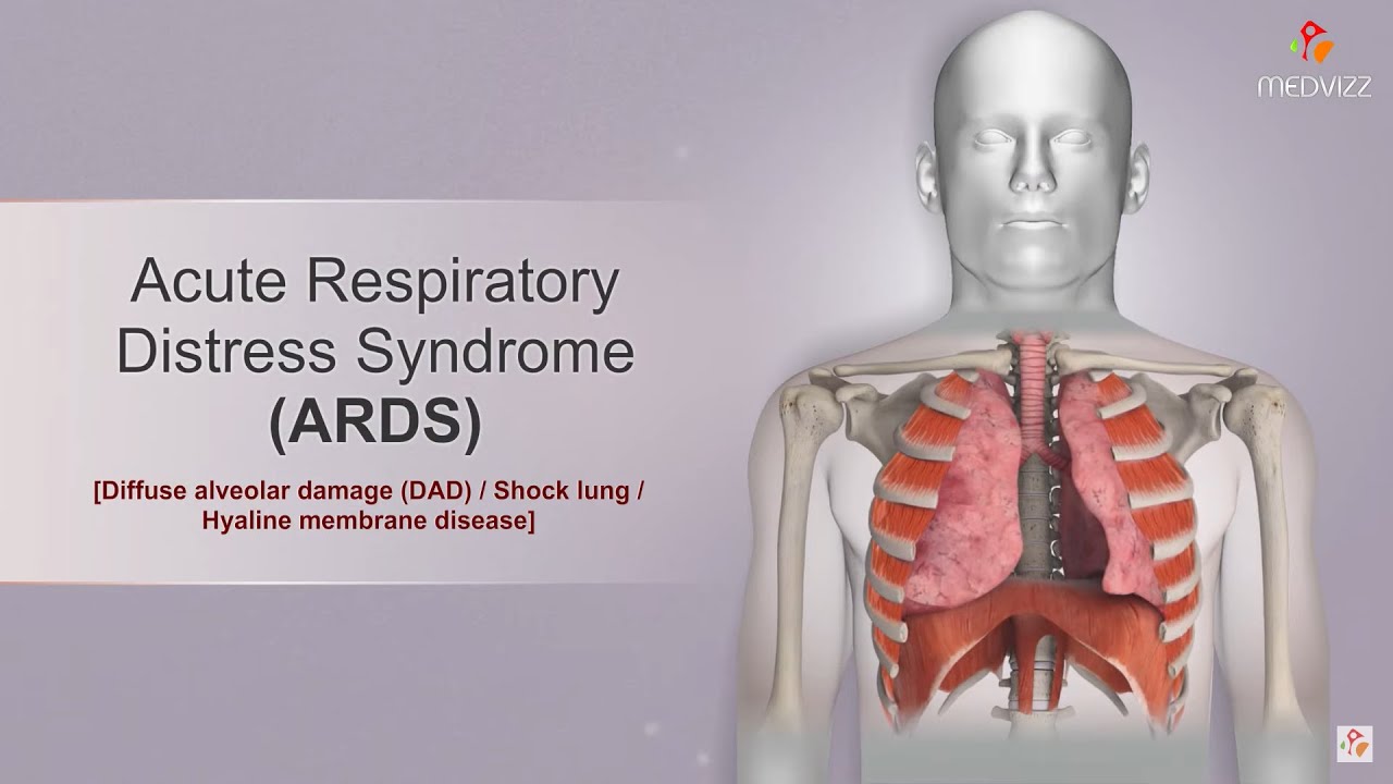 What is the full form of ARDS?