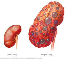 What is the full form of PKD?