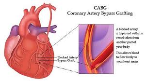 What is the full form of CABG?